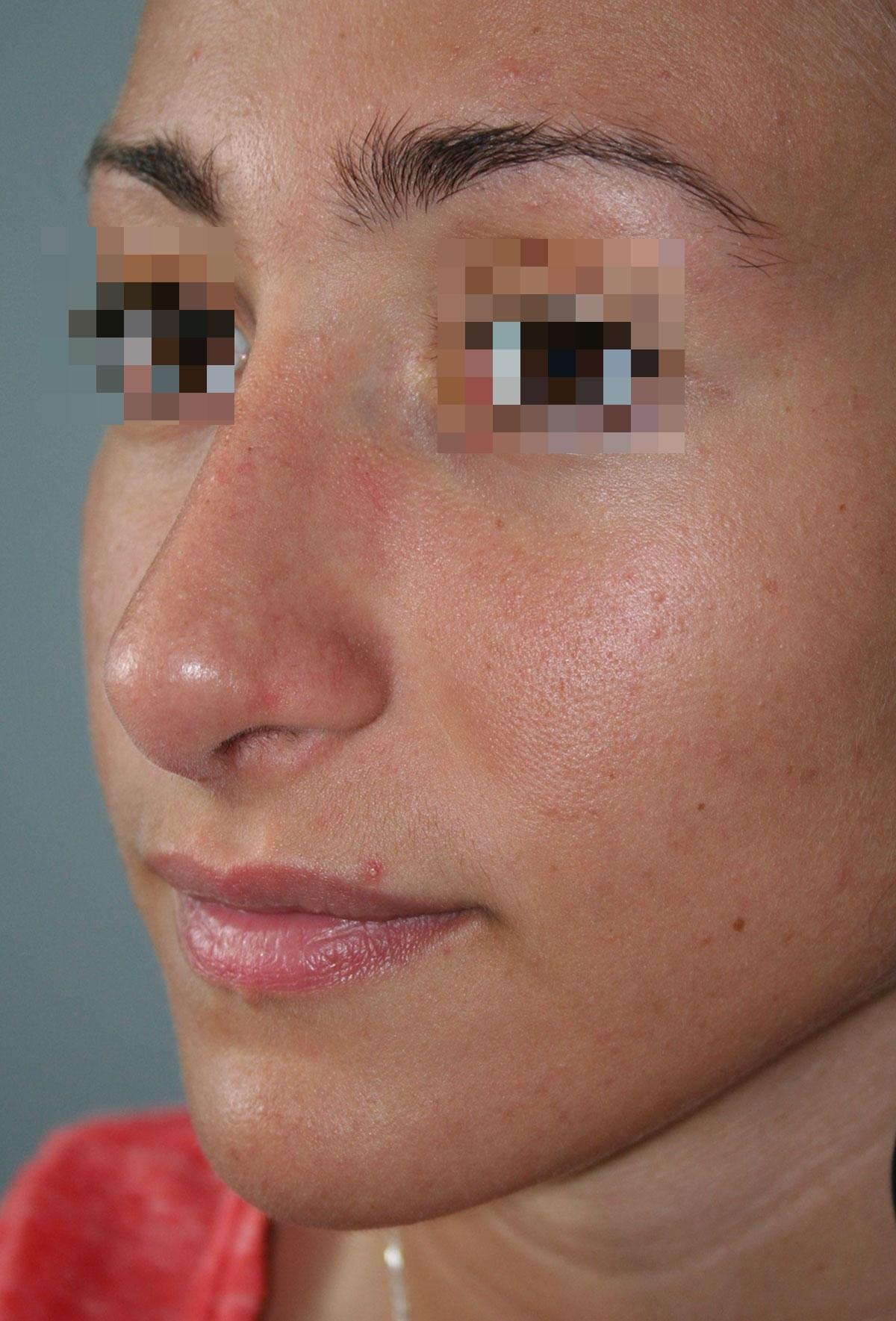 After image